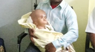 बिलासपुर: डॉक्टरों ने किया कमाल, दो सिर वाले बच्चे को दी नई जिंदगी