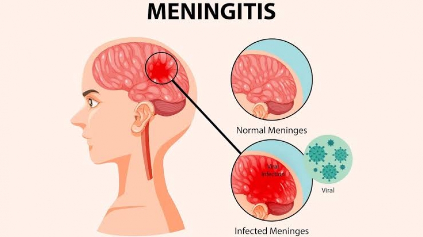 World Meningitis Day:मेनिनजाइटिस क्या है और कितनी ख़तरनाक है ये बीमारी ? लक्षणों के साथ जानें बचाव का तरीका